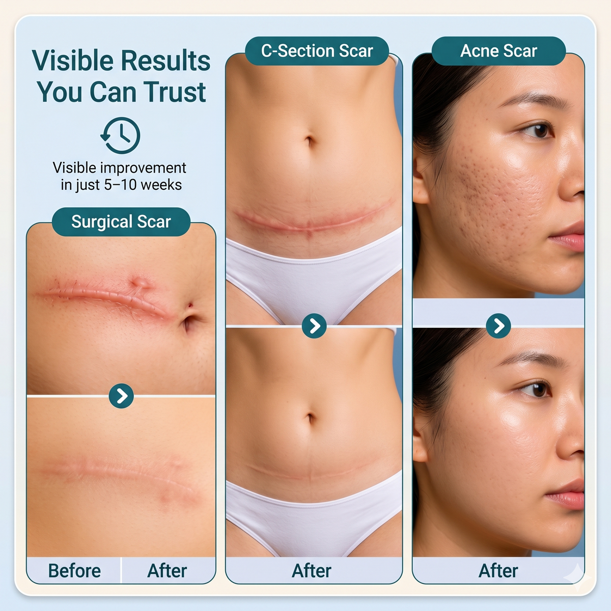 HealTape Pro- For Surgical, Burn & Acne Scars | Skin Healing Tape  |  Women & Men